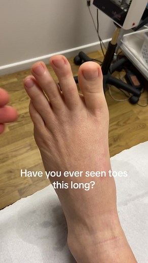 Long Toes: Have You Ever Seen Toes This Long?