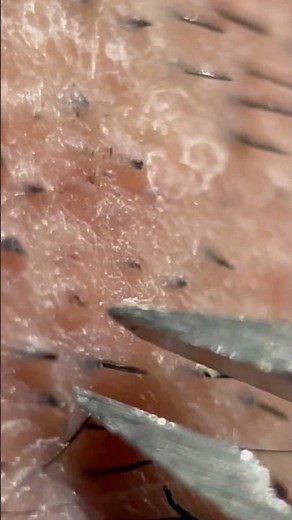 毛抜き動画随時更新中🥺