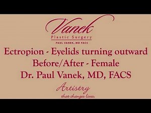 Ectropion - Diagnosis, and Treatment