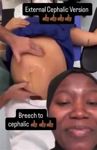 Changing Breech to Cephalic Presentation in Pregnancy