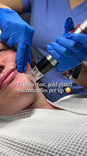 Genius RF doesn’t just treat the surface, but it doesn’t go too deep either 🤍 It uses tiny microneedles to deliver radiofrequency energy at a controlled depth in the skin, where collagen is actually produced. That heat gently stimulates collagen and elastin, helping tighten skin, smooth texture, and improve firmness over time without damaging the surface. Book with us today! #MedSpaSanAntonio #Injector #Microneedling