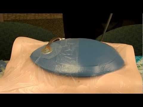 Damage Control: Applying the KCI ABThera