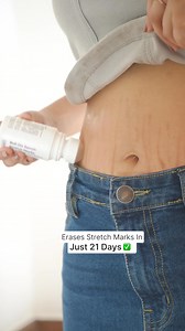 Are stretch marks stopping you from wearing your favourite outfits? 💔 Not anymore! Introducing the 3-Week Intense Stretch Marks Eraser Roll-On— fade marks, tighten skin, and even out tone. Backed by science and trusted by experts! ✔️ Backed by shark Vineeta ✔️ Non-sticky, easy-to-use roll-on. ✔️ Visible results in just 21 days. | COSIQ - Intelligent Skincare