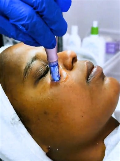 Pdrn facial treatments in jemo kaku Building 4thfloor @LA Aesthetics #creatorsearchinsights #pdrn #microneedling #viralvideo #foryou @LA Aesthetics Centre