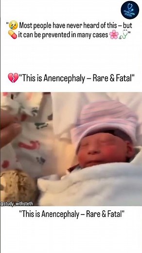 💔 Baby born without a brain — Anencephaly. Awareness saves lives. 🩺💊 #MedicalFacts #Awareness #mbbs