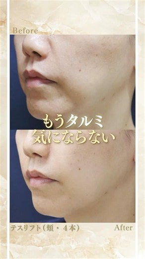 ◆施術内容◆症例 9 テスリフト（頬・4本） 標準的な治療費用 220,000 円 （税込）◆リスクと合併症◆左右差、引きつれ感、内出血、感染など