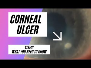 Corneal Ulcer!? This is a True Eye Infection! Learn About Microbial Keratitis and Contact Lenses