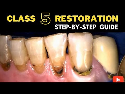 Class V Composite Restoration Procedure Guide • Video • MEDtube.net