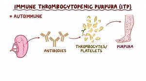 Video: Immune thrombocytopenia - Video Explanation! | Osmosis | Osmosis