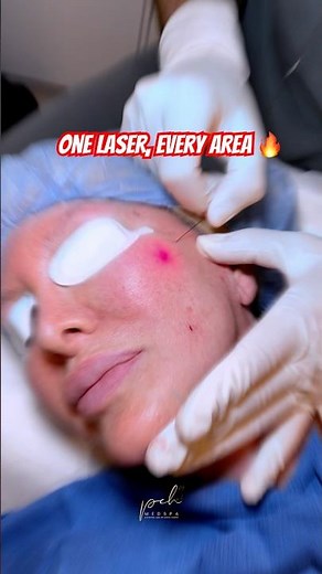 Where Can Endolift Treat? | Full Face & Body Laser Lift Explained!