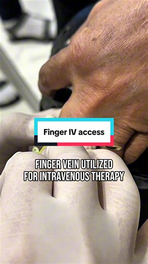 A finger vein may also be accessed if no other viable veins are available