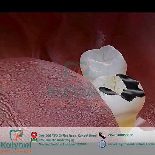 "Cavity Treatment Guide: How Dentists Clean & Fill Cavities"