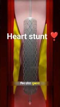 Why Is a Heart Stent So Expensive? (Shocking Truth)