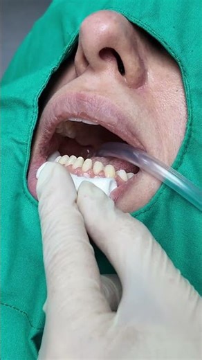 The Secret to a Perfect Smile with Laminated Veneers! ✨💎 #LaminatedVeneers #SmileDesign