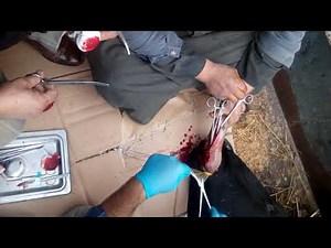 Partial ventral glossectomy 3