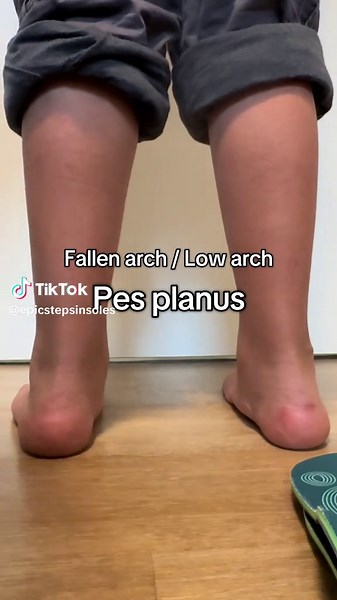 Effective Solutions for Flat Feet and Arch Support