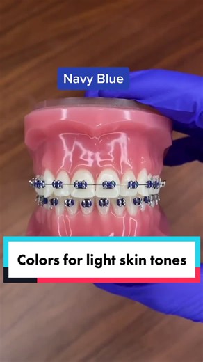 Best Braces Colors for Light Skin: Tips and Ideas