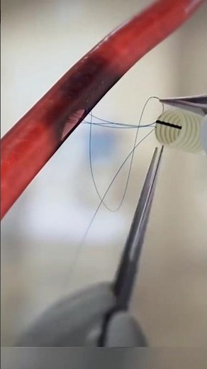 Bypass Grafting Surgery (Coronary Artery Bypass Grafting - CABG)