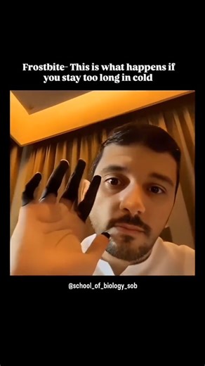 Schoolof Biology on Instagram: "Severe frostbite in fingers occurs when the skin and underlying tissues freeze due to prolonged exposure to extreme cold. In advanced stages, fingers may become hard, cold, and numb, with a pale, waxy, or bluish-black appearance. Blisters may form, and tissue damage can be extensive, sometimes leading to gangrene. This level of frostbite can cause permanent nerve damage or require amputation if blood flow isn’t restored promptly. Immediate medical attention is cri