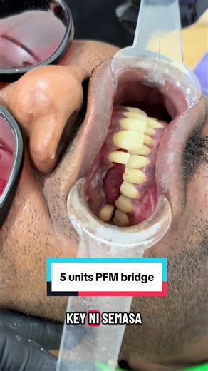 Gigi Palsu Lekat 5 Unit (Dental Bridge) — Proses & Perawatan