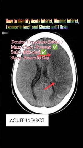 How to Identify Acute Infarct, Chronic Infarct, Lacunar Infarct, and Gliosis on CT Brain..
