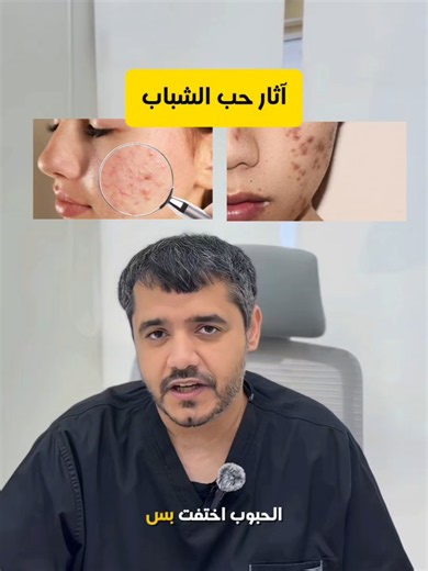 How to Get Rid of Acne Scars: Red and Brown Types