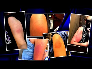 ‘COVID Arm’ Rash After Vaccine Is Actually Proof It’s Working