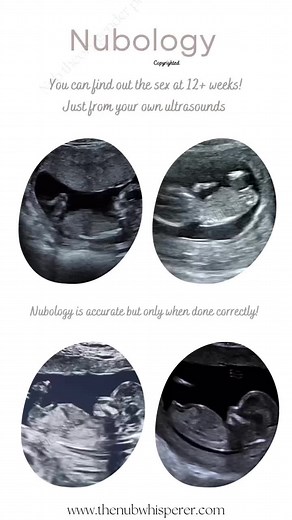 Nubs are a passion of mine! And have been for 10 years now! Wow! I have probably seen a million nubs by now. I have personally come up with the term “Nubolgy” instead of using theory! Because that word seriously weds to go! Hopefully it catches on! So if you hear that term.. it’s from me 😜🙈 I want everyone to believe that when doing this correctly with the right settings (age/visibility/full Nub) it is highly accurate. Nubs are not false, they are real. The big development week is 12 weeks ges