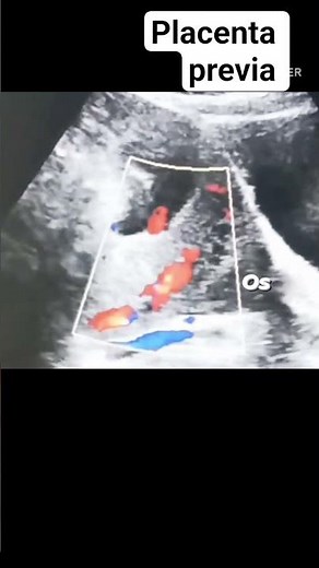 Placenta previa on ultrasound #ultrasound #pregnant