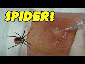 Spider Bites and Possible Spider Bites Treated