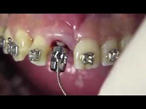 Extração dentária com uso do Benex