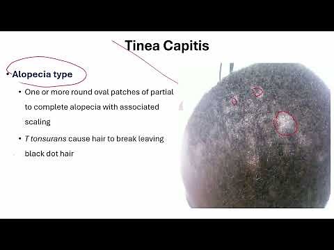 Tinea Capitis Tips and Tricks