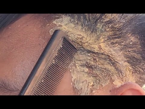 ASMR Scalp Scratching for Sleep and Relaxing Care #761