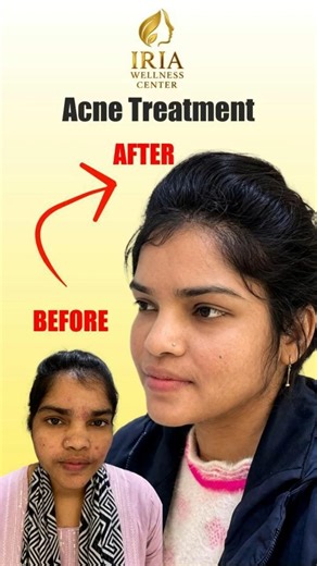 Acne Treatment Before After | Real Skin Transformation at IRIA Wellness Kanpur | 8188020525 | #acne
