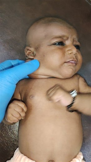 😱🩺 Doctor’s Heart-Stopping Moment: Baby’s Neck Lump Could Be More Than It Seems! A worried family brought their little baby to the pediatric clinic with a large lump on the neck. What appeared to be a simple swelling could turn out to be something dangerous and life-changing. Watch this emotional and educational journey as the doctor examines, explains possible causes, and guides the parents through this frightening moment. 👉 This video is for medical education and parents’ awareness only. 🚫