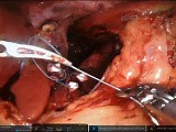 Robotic Cruroplasty (Hiatoplasty) and Nissen Fundoplication for GERD and type-1 Hiatal Hernia • Video • MEDtube.net