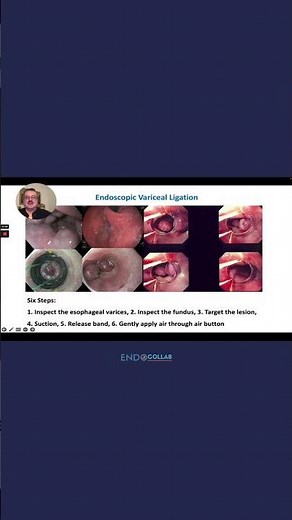 The Six Steps of Endoscopic Variceal Ligation.