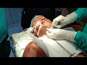 Submental intubation