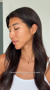 We don’t just fight breakouts, we also fade the marks they leave behind, thanks to our Obagi Nu-Derm® Fx System💙 With any good AM routine, don’t forget to finish with your broad spectrum SPF DISCOVER #THEOBAGIEFFECT To learn more about Obagi products: Find an Obagi professional near you (link in bio) or Visit Obagi.com #acne #acnetreatment #acnescars #acnescarring #obagi | Obagi Medical