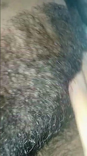 ingrown hair removal #IngrownHairRemoval #IngrownHair #HairRemoval #Skincare