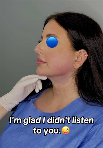 Double chin liposuction before and after results. ✅ #chinlipo #chinliposuction #chinlipocheck #chinliporecovery #chinlipoupdate #doublechinlipo #doublechin #fyp #fypp #fypage #foryou #foryoupage #foryourpage #beauty #beforeandafter #viraltiktok #viralvideo #trendingvideo #transformation #change