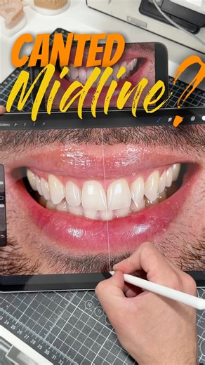 Is your midline off?This is a simple way to plan ahead before starting your #waxup #smilemakeover