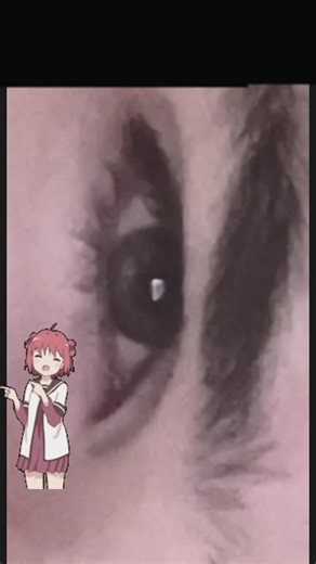 Understanding Hunter Eyes and Medical Canthus