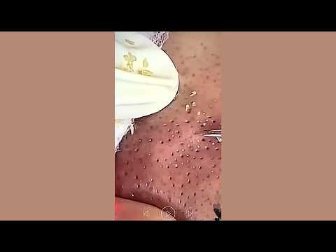 Skincare | Blackheads Removal #843 #tweezers skincare #blackheads blackheads