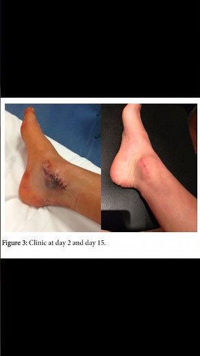 Medial Malleolar Bursa Explained #anklepain #bursitis #ATC #physio #ortho #anatomy