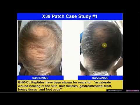 Hair Restoration Before and After 6 Weeks with Lifewave X39 Patches Dr Andrew Rostenberg