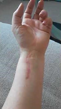 Distal Radius Fracture Exercises