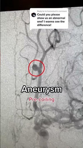 Cerebral Angiogram
