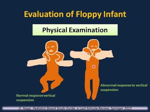 The Floppy Infant: Hypotonia