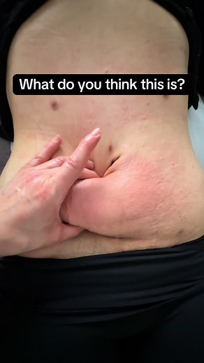 Understanding Liposuction Recovery: Insights Beyond Swelling